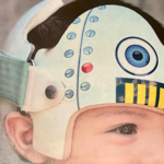 赤ちゃんのヘルメット治療①－大まかな流れ